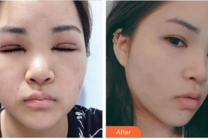 合肥名人眼科醫(yī)院劉紅整形價(jià)格表附眼部綜合案例展示