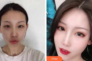 合肥名人眼科醫(yī)院張照珍整形價(jià)格表附眼部綜合案例展示