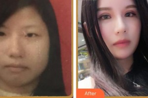 合肥名人眼科醫(yī)院楊友俊整形價(jià)格表附眼部綜合案例展示