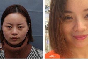 合肥名人眼科醫(yī)院岳春整形價(jià)格表附重瞼修復(fù)術(shù)+上瞼提肌矯正術(shù)案例展示