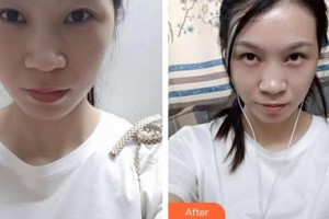 合肥愛爾眼科醫(yī)院朱華美整形價(jià)格表附眼部修復(fù)案例展示