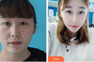 合肥愛爾眼科醫(yī)院蔣寶霖整形價(jià)格表附眼部綜合案例展示