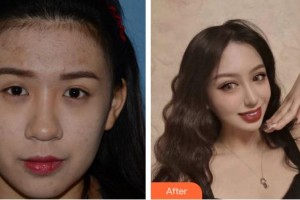 合肥愛爾眼科醫(yī)院陳國(guó)府整形價(jià)格表附眼部綜合案例展示