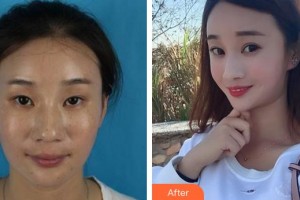 合肥愛爾眼科醫(yī)院劉帥帥整形價(jià)格表附眼部整形案例展示