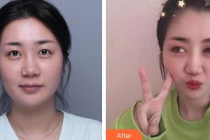 合肥愛爾眼科醫(yī)院謝道勝整形價(jià)格表附雙眼皮案例展示