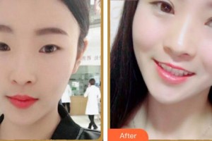 合肥愛爾眼科醫(yī)院李凱整形價(jià)格表附雙眼皮案例展示