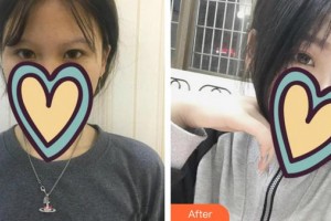 合肥愛爾眼科醫(yī)院王芳榮整形價(jià)格表附眼部案例展示