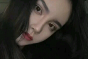 長(zhǎng)沙愛(ài)思特醫(yī)療美容醫(yī)院陶婭整形價(jià)格表附埋線提升案例展示