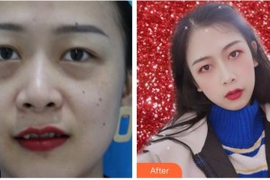 合肥愛爾眼科醫(yī)院張玉整形價(jià)格表附祛眼袋案例展示