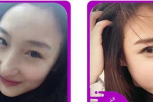 合肥愛爾眼科醫(yī)院劉勇整形價(jià)格表附眼部綜合案例展示