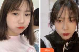 合肥愛爾眼科醫(yī)院曹艷整形價格表附眼部綜合案例展示