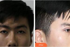 合肥愛爾眼科醫(yī)院李萍整形價格表附埋線雙眼皮案例展示