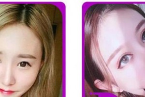 合肥愛爾眼科醫(yī)院遲強強整形價格表附眼部綜合案例展示