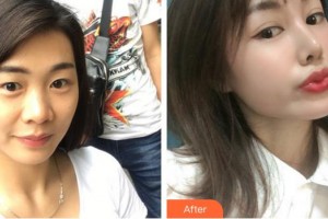 合肥愛爾眼科醫(yī)院郭云飛整形價格表附定點雙眼皮案例展示