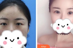 合肥愛爾眼科醫(yī)院楊秀敏整形價格表附眼部綜合案例展示