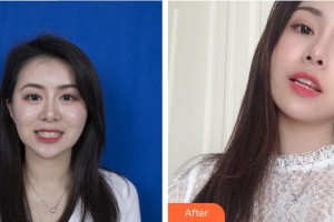 合肥市口腔醫(yī)院孫珍整形價格表附隱形矯正案例展示