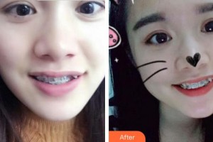 合肥市口腔醫(yī)院劉昕整形價格表附金屬托槽矯正案例展示