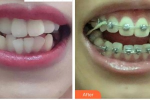 合肥市口腔醫(yī)院張富華整形價格表附金屬托槽矯正案例展示