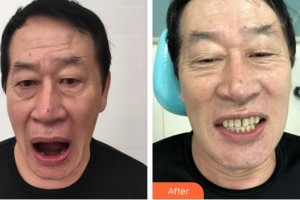 合肥瑞特曼口腔門診部魏敬謙整形價格表附種植牙案例展示