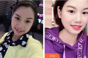 合肥靚美口腔醫(yī)院王懷元整形價格表附牙齒矯正案例展示