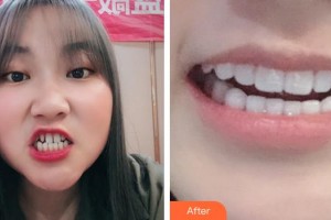 合肥拜博口腔醫(yī)院程旭整形價格表附牙貼面案例展示