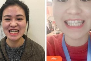 合肥拜博口腔醫(yī)院杜紅保整形價格表附冷光美白案例展示