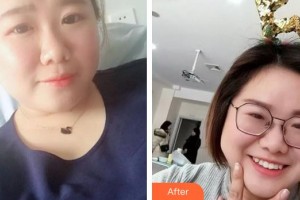 合肥貝杰口腔醫(yī)院焦宏春整形價格表附牙齒隱形矯正案例展示