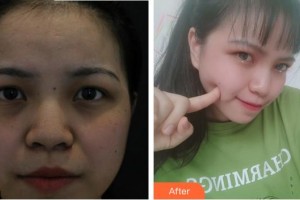 合肥東南眼科醫(yī)院趙丹丹整形價(jià)格表附眼部綜合案例展示