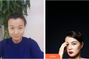 合肥東南眼科醫(yī)院張志明整形價(jià)格表附切開(kāi)雙眼皮案例展示