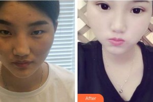 合肥東南眼科醫(yī)院汪澤整形價(jià)格表附切開(kāi)雙眼皮案例展示