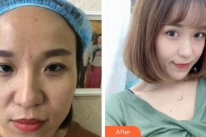 合肥東南眼科醫(yī)院杭煒整形價(jià)格表附眼部修復(fù)案例展示