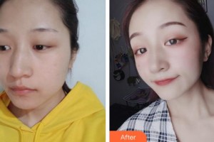 合肥東南眼科醫(yī)院夏博整形價(jià)格表附開(kāi)內(nèi)眼角案例展示