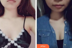 蕪湖華美醫(yī)療美容診所高翠華整形價(jià)格表附假體隆胸案例展示