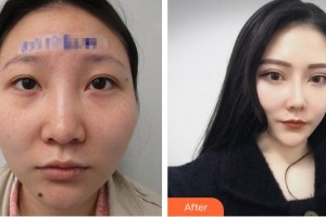 蕪湖瑞麗醫(yī)療美容門診部戴露倢整形價(jià)格表附眼部案例展示