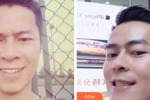 蕪湖美人魚(yú)醫(yī)療美容醫(yī)院王俊整形價(jià)格表附金屬托槽矯正案例展示