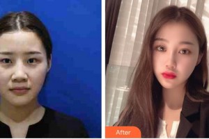 蕪湖眼科醫(yī)院（弋江區(qū)醫(yī)院）李燕整形價(jià)格表附雙眼皮案例展示