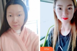 蕪湖眼科醫(yī)院（弋江區(qū)醫(yī)院）韓林峰整形價(jià)格表附切開(kāi)雙眼皮案例展示