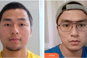 蕪湖眼科醫(yī)院（弋江區(qū)醫(yī)院）史椰欖整形價(jià)格表附切開(kāi)雙眼皮案例展示