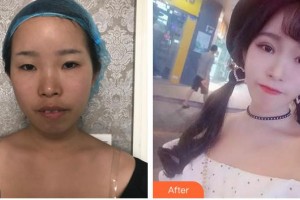 蕪湖眼科醫(yī)院（弋江區(qū)醫(yī)院）高際平整形價(jià)格表附切開(kāi)雙眼皮案例展示