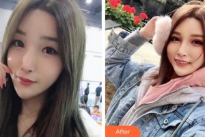 蕪湖愛(ài)爾眼科醫(yī)院王飛整形價(jià)格表附眼部修復(fù)案例展示