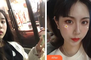 蕪湖眼科醫(yī)院（弋江區(qū)醫(yī)院）李惠整形價(jià)格表附雙眼皮案例展示