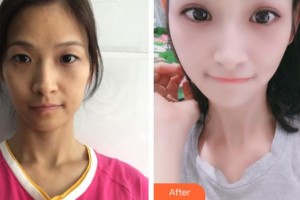 蚌埠國色整形美容醫(yī)院朱寶玉整形價格表附眼部綜合案例展示