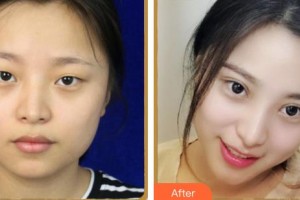 蚌埠國色整形美容醫(yī)院丁美哲整形價格表附眼部綜合案例展示