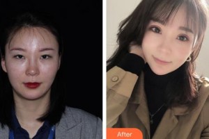 蚌埠華美整形美容門診部剛整形價格表附眼部綜合案例展示