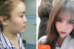 蚌埠醫(yī)學(xué)院第二附屬醫(yī)院整形外科陶思一整形價格表附鼻部手術(shù)案例展示