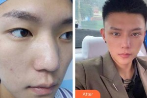 蚌埠美萊塢整形美容醫(yī)院蔣興貌整形價格表附膨體隆鼻案例展示