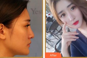 蚌埠華美整形美容門診部趙輯整形價格表附鼻部綜合案例展示
