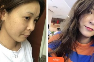 蚌埠華美整形美容門診部王榮堂整形價格表附激光美膚激光案例展示