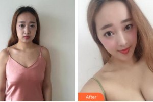 蚌埠市第三人民醫(yī)院燒傷整形科許瑾整形價格表附假體隆胸案例展示