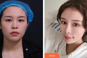 蚌埠市第三人民醫(yī)院燒傷整形科章祥洲整形價格表附鼻部綜合案例展示